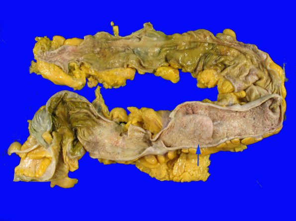 2A1 Infarct, embolic (Case 2) Colon copy