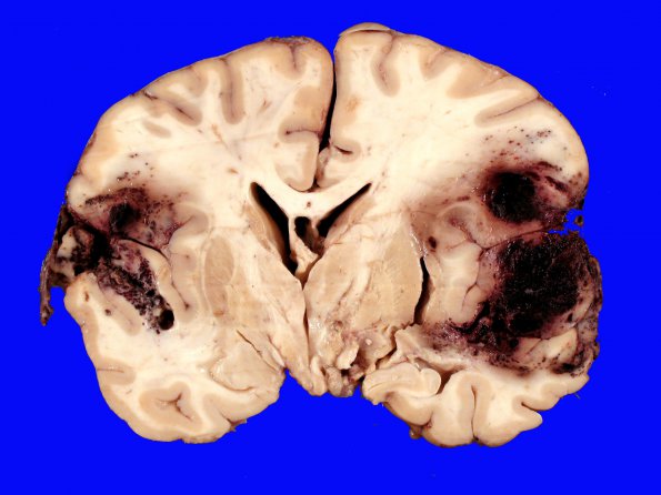 2A2 Infarct, embolic (Case 2) CNS _4