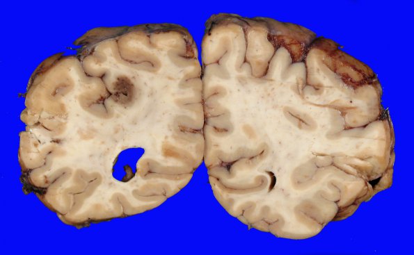 2A3 Infarct, embolic (Case 2) CNS _6