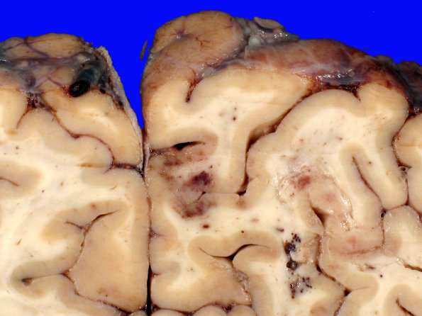 2A4 Infarct, embolic (Case 2) CNS _7