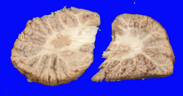 2A5 Infarct, embolic (Case 2) CNS _9