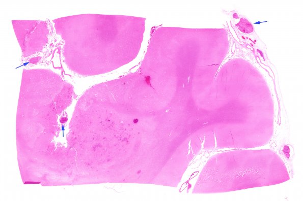 2B1 Infarct, embolic (Case 2) H&E whole mount 6 copy