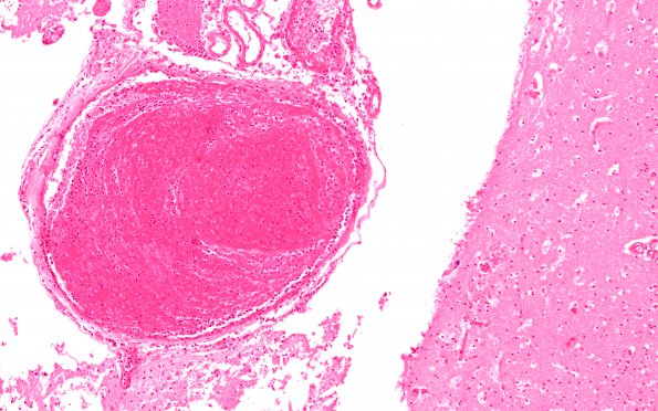 2B2 Infarct, embolic (Case 2) H&E whole mount 6 copy