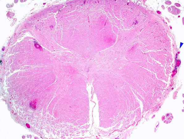 2C2 Infarct, embolic (Case 2) H&E 7C spinal cord copy