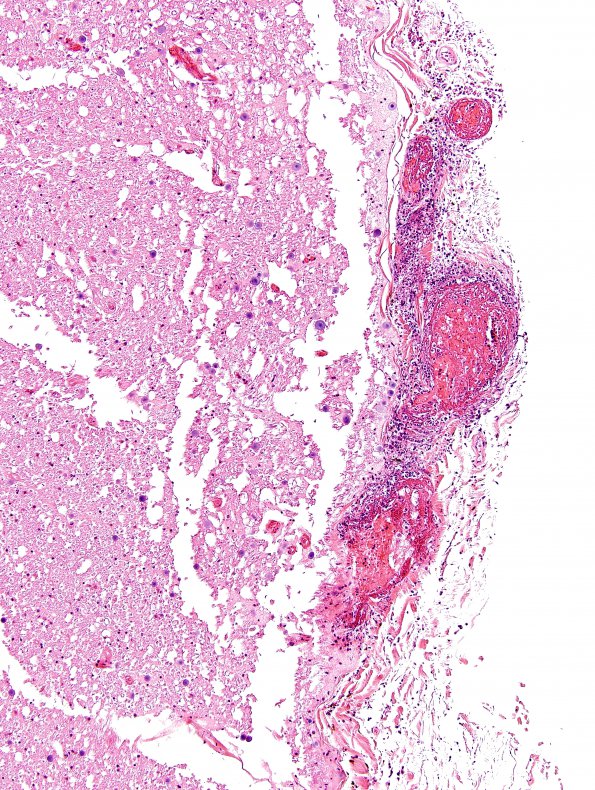 2C3 Infarct, embolic (Case 2) H&E 7A spinal cord