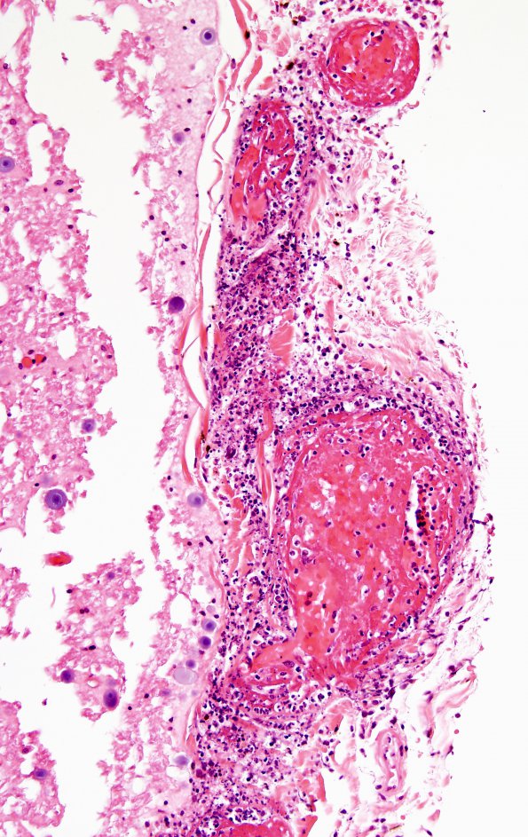 2C4 Infarct, embolic (Case 2) H&E 7 spinal cord