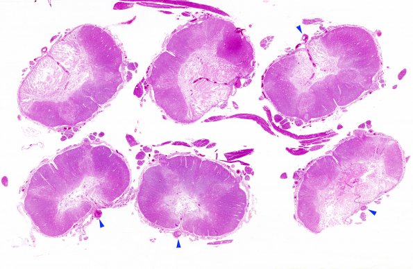 3B1 Infarct, spinal cord, remote (Case 3) H&E whole mount copy A