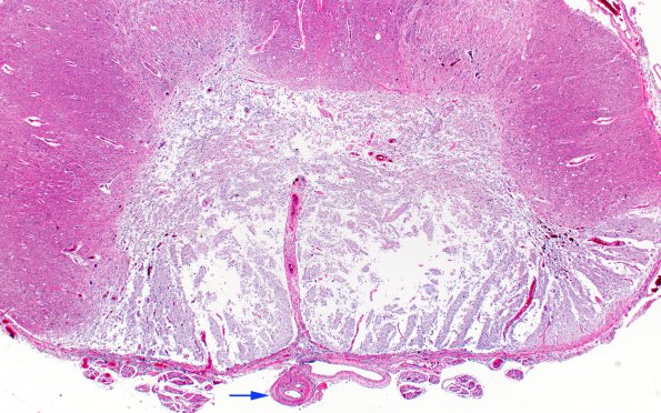 3B2 Infarct, spinal cord, remote (Case 3) N13 H&E 2X Acopy