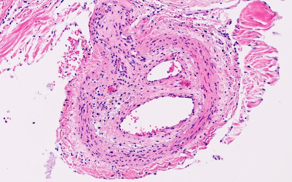 3B3 Infarct, spinal cord, remote (Case 3) N13 H&E 20X