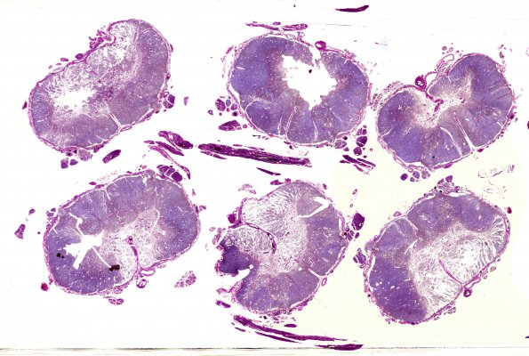 3C1 Infarct, spinal cord, remote (Case 3) N13 VVG WM