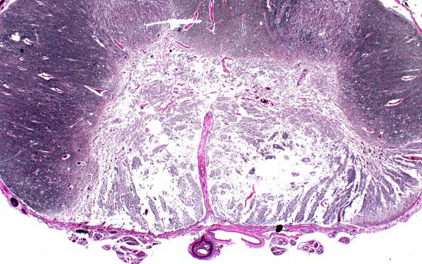 3C2 Infarct, spinal cord, remote (Case 3) N13 VVG 2X