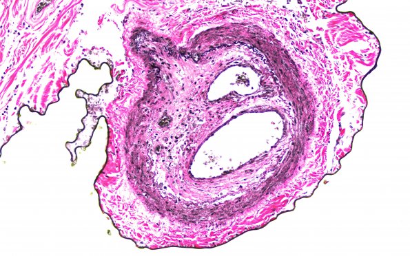 3C3 Infarct, spinal cord, remote (Case 3) N13 VVG 20X 2