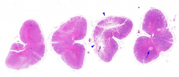 4A1 Infarct, subacute spondylosis (Case 4) N11 H&E WM copy