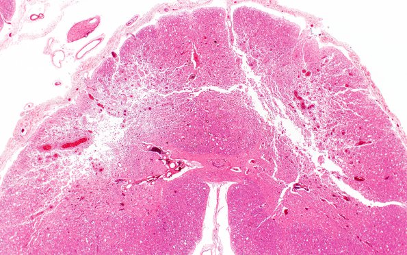 4A2 Infarct, subacute spondylosis (Case 4) N11 H&E 2X 2