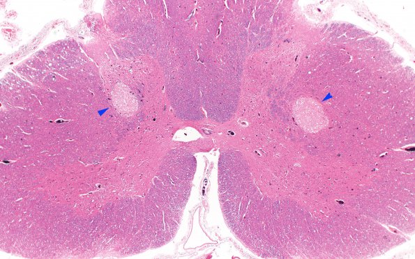 4A4 Infarct, subacute spondylosis (Case 4) N11 H&E 2X copy