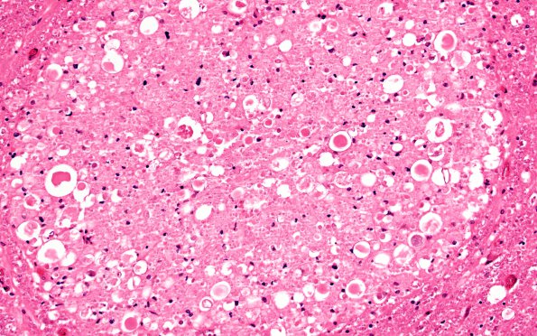 4A6 Infarct, subacute spondylosis (Case 4) N11 H&E 20X