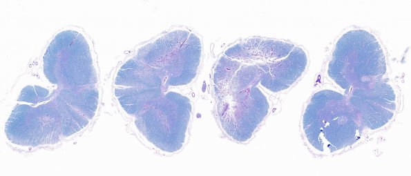 4B1 Infarct, subacute spondylosis (Case 4) N11 LFB-PAS WM