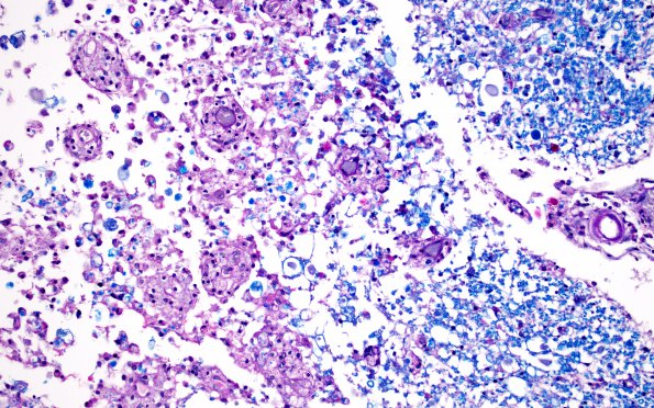 4B2 Infarct, subacute spondylosis (Case 4) N11 LFB-PAS 20X