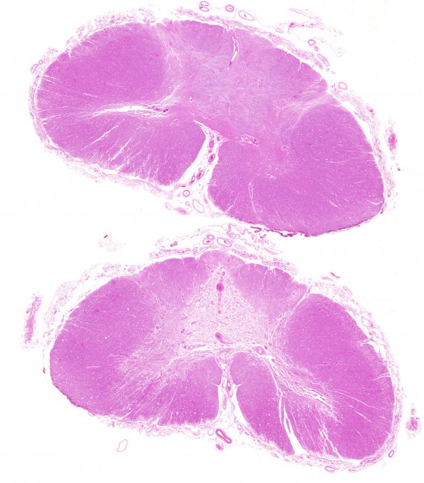 5A1 Infarct, subacute spinal cord (Case 5) H&E WM