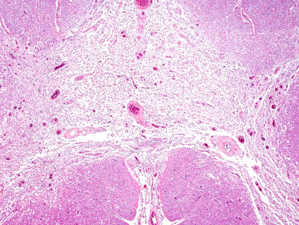 5A2 Infarct, subacute spinal cord (Case 5) H&E 2