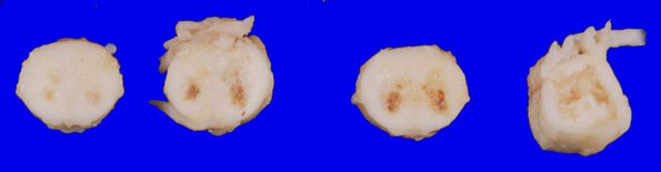 6A1 Infarct, spinal cord (Case 6)