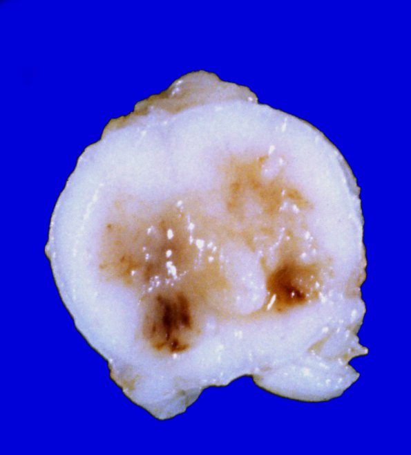 6A2 Infarct, spinal cord (Case 6) 2