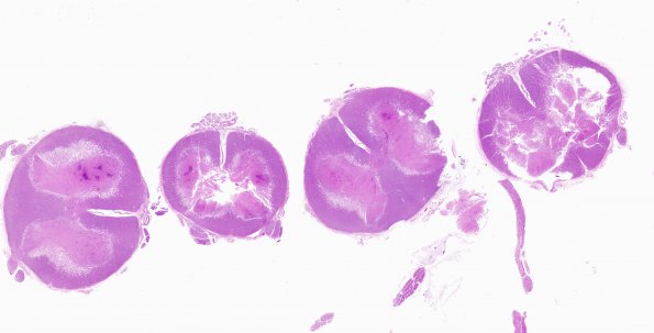 6B1 Infarct, spinal cord (Case 6) N10E H&E WM