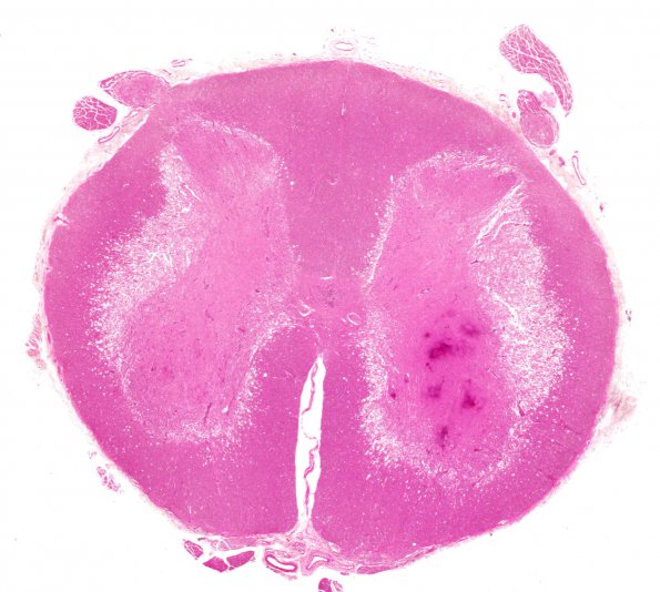 6B2A Infarct, Subacute, spinal cord (Case 6) A