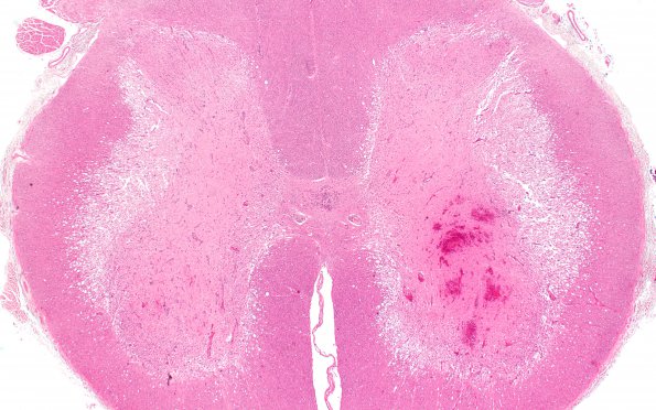 6B2B Infarct, spinal cord (Case 6) N10E H&E 1