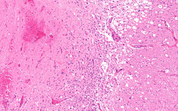 6B4 Infarct, spinal cord (Case 6) N10E H&E 3