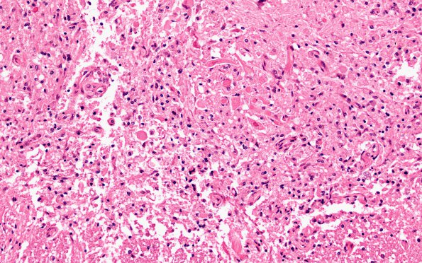 6B5 Infarct, spinal cord (Case 6) N10E H&E 20X