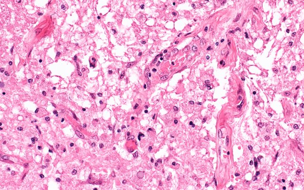 6B6 Infarct, spinal cord (Case 6) N10E H&E 1