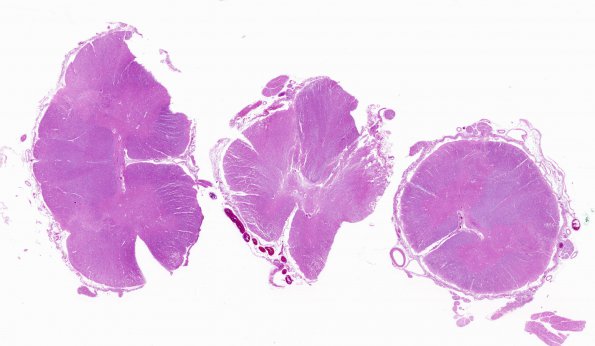 7A1 Infarct, adjacent, spinal cord (Case 7) H&E WM