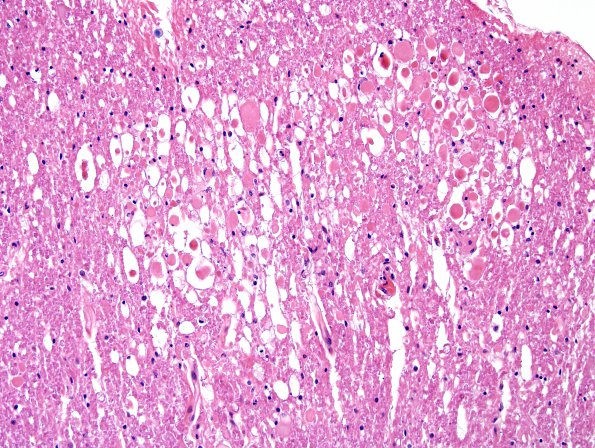 7A2 Infarct, adjacent, spinal cord (Case 7) H&E 1