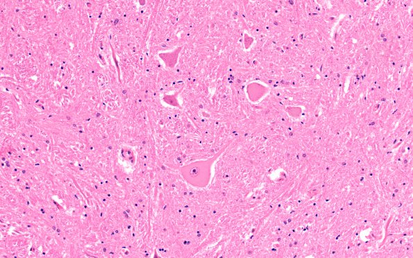 7A4 Infarct, adjacent, spinal cord (Case 7) H&E 5