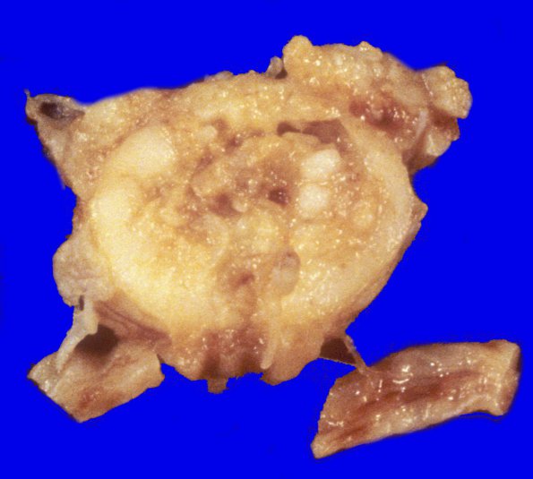 8A1 Infarct, spinal cord (Case 8) 1