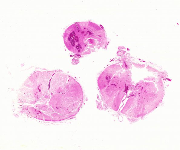 8B1 Infarct, spinal cord (Case 8) WM 2