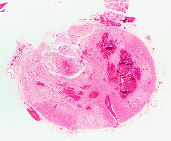 8B2 Infarct, spinal cord (Case 8) N10C H&E 2X