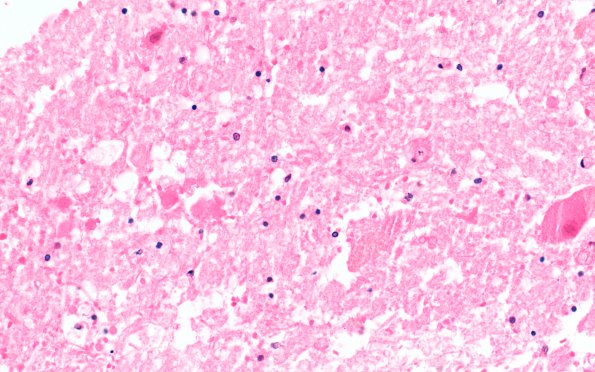 8B3 Infarct, spinal cord (Case 8) N10B H&E 40X