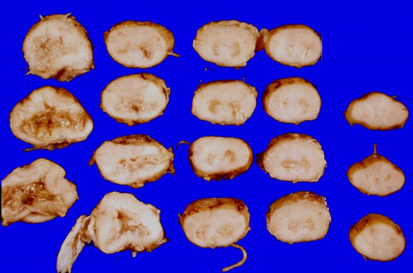 9A1 Infarct, spinal cord, aortic aneurysm (Case 9)