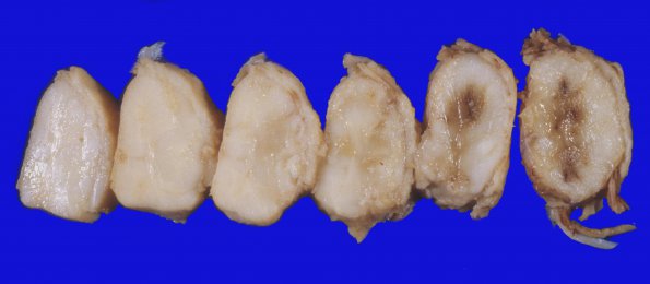 9A2 Infarct, spinal cord, aortic aneurysm (Case 9) (2)