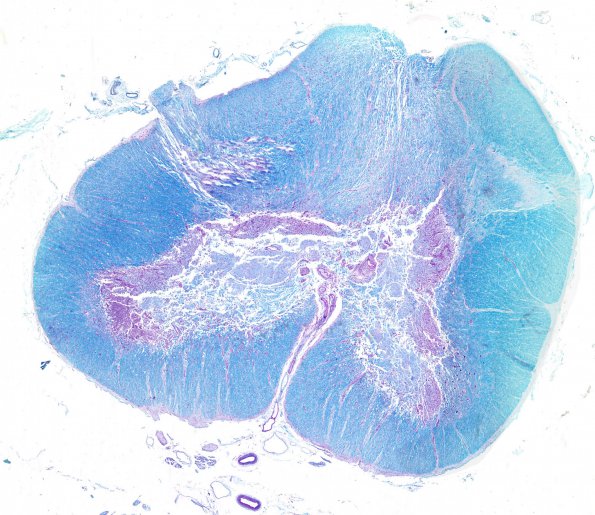 9B Infarct, spinal cord, aortic aneurysm (Case 9)  WM 2