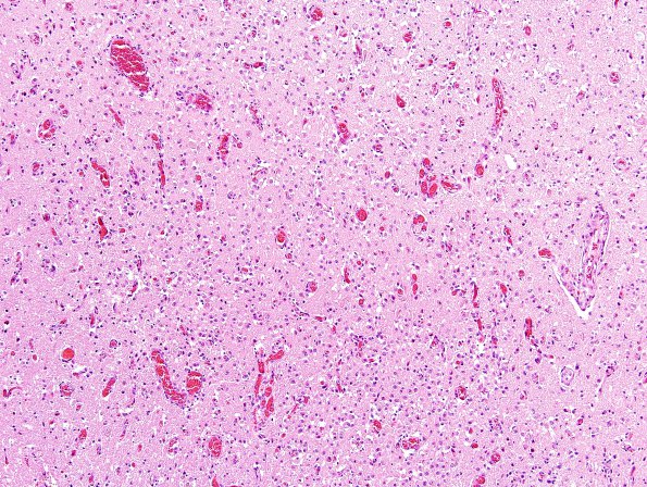 10A1 Infarct, subacute (Case 10) L2 H&E 1A