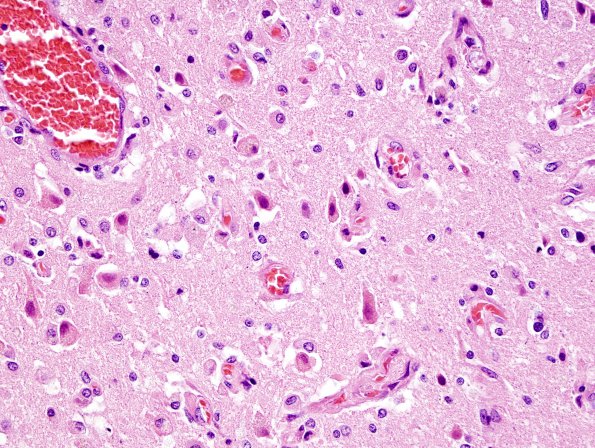 10A2 Infarct, subacute (Case 10) L2 H&E 4