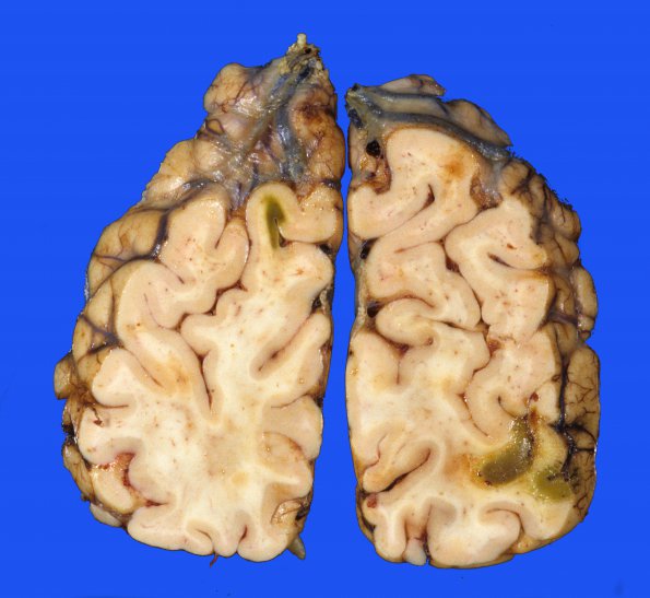 11A1 Infarct, subacute (Case 11) bilirubin 1