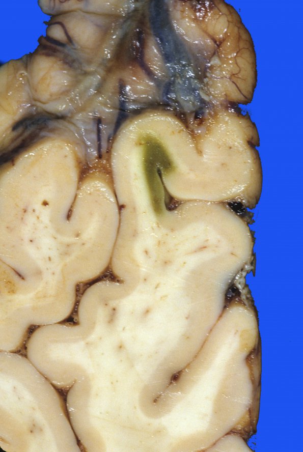 11A2 Infarct, subacute (Case 11) bilirubin 2