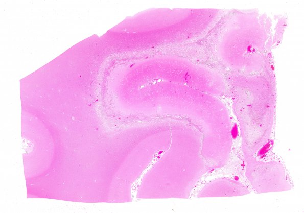 11B1 Infarct, bilirubin stain (Case 11) N11