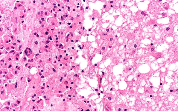 11B5 Infarct, bilirubin stain (Case 11) 40X 2A