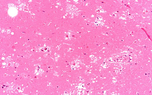 11B6 Infarct, bilirubin stain (Case 11) 20X BR area