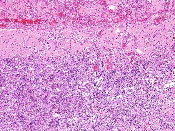 14A1 Infarct, subacute (Case 14) H&E 1